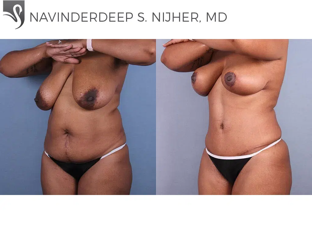 Before and After Image: Abdominoplasty (Tummy Tuck) Case #70212 - left-front-oblique