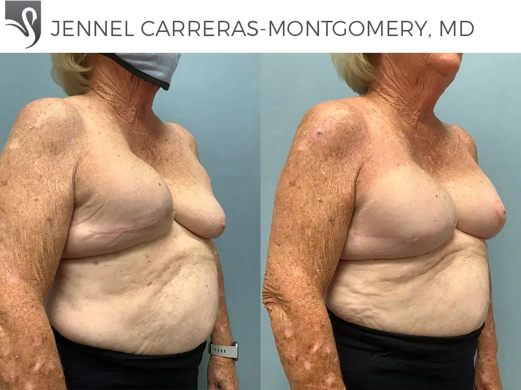 Before and After Image: Breast Reconstruction Case #70285 - right-front-oblique