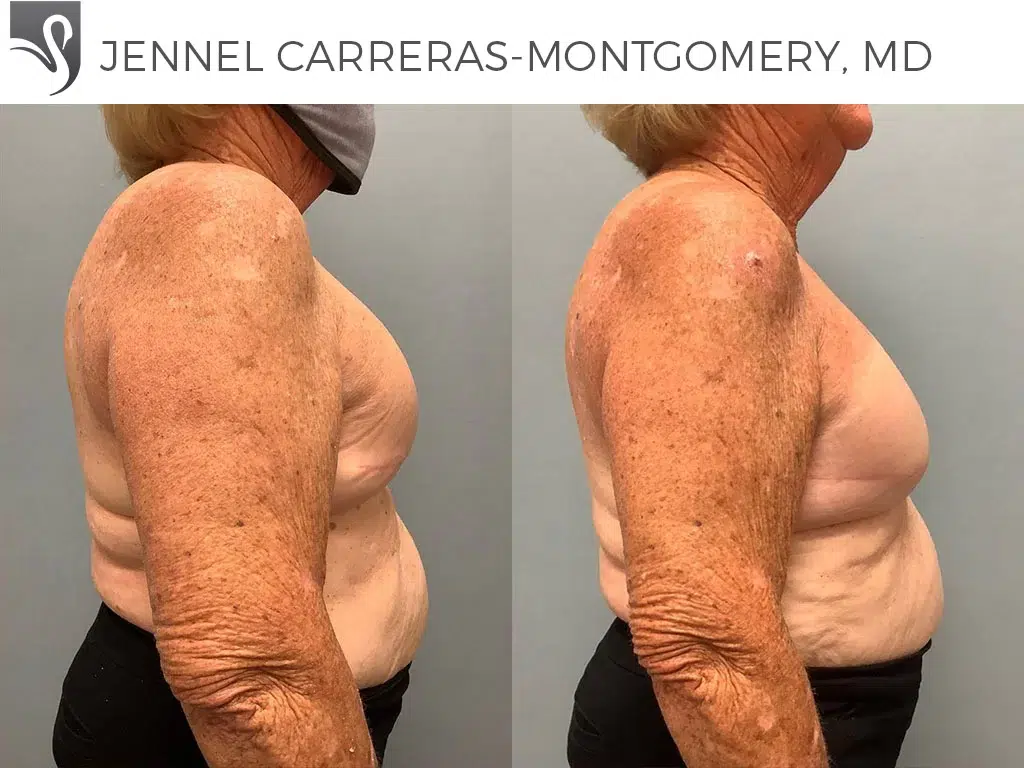 Before and After Image: Breast Reconstruction Case #70285 - right-side