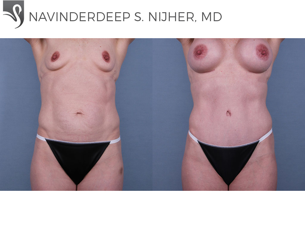Before and After Image: Abdominoplasty (Tummy Tuck) Case #70328 - front
