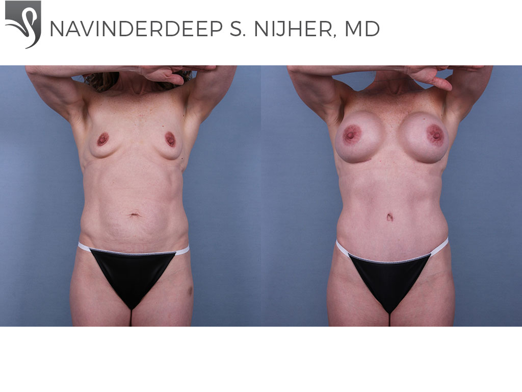 Before and After Image: Mommy Makeover Case #70328 - front