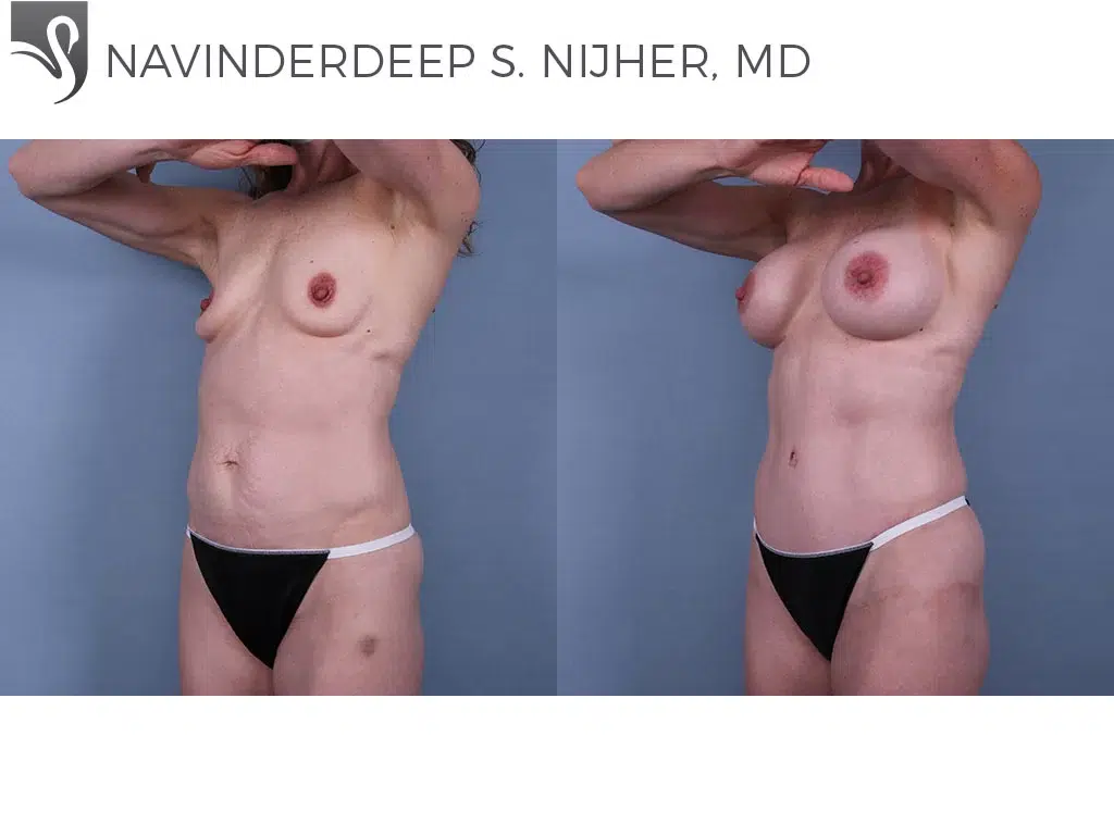 Before and After Image: Mommy Makeover Case #70328 - left-front-oblique