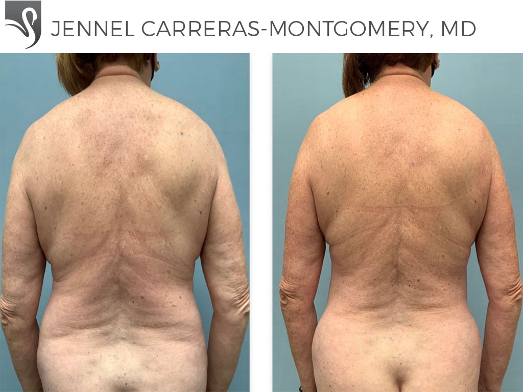 Before and After Image: Liposuction Case #70376
