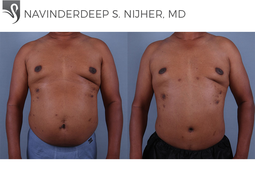 Before and After Image: Abdominoplasty (Tummy Tuck) Case #70379 - front