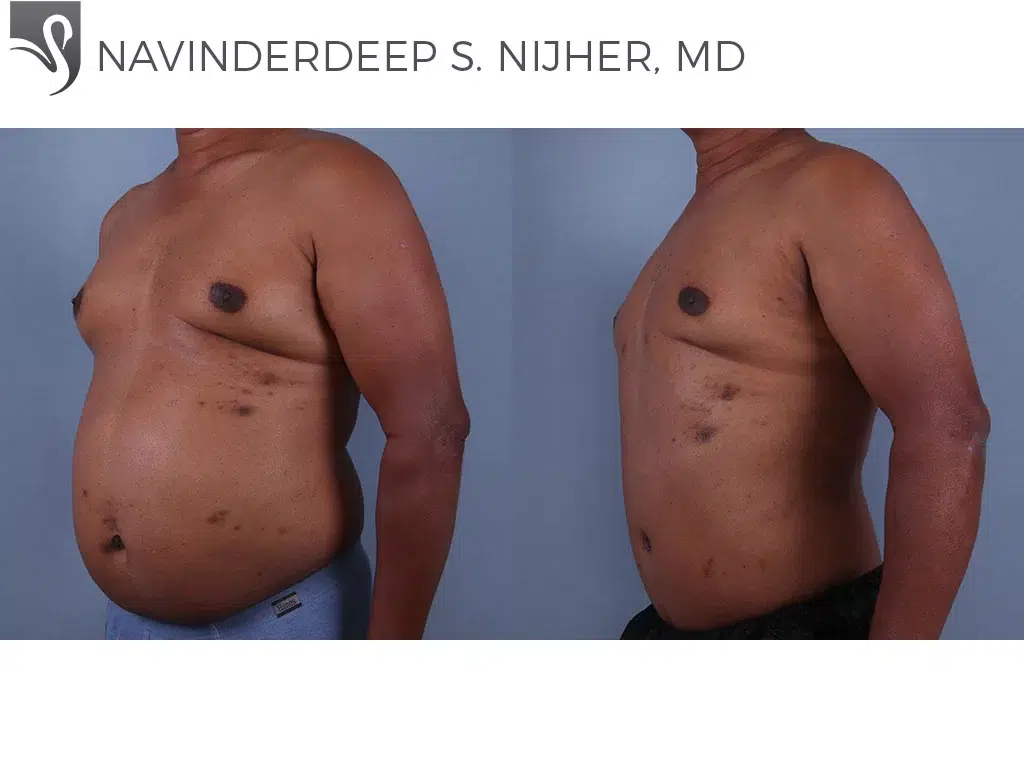 Before and After Image: Abdominoplasty (Tummy Tuck) Case #70379 - left-front-oblique