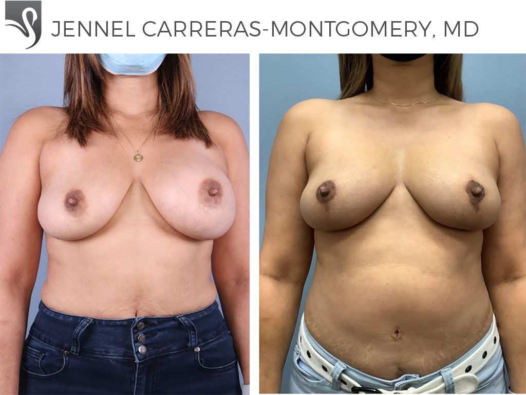 Before and After Image: Breast Lift (Mastopexy) Case #70433