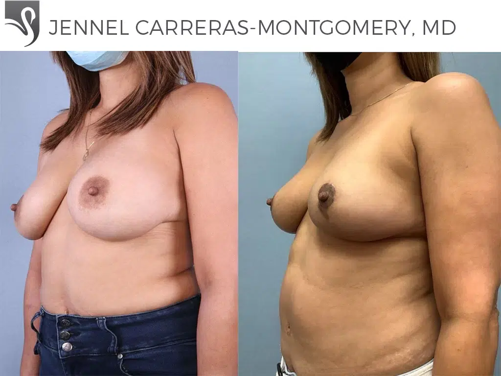 Before and After Image: Breast Lift (Mastopexy) Case #70433 - left-front-oblique