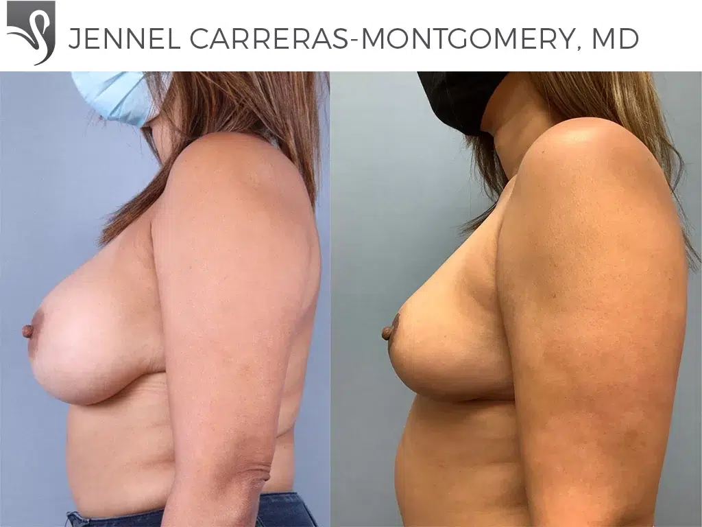 Before and After Image: Breast Lift (Mastopexy) Case #70433 - left-side