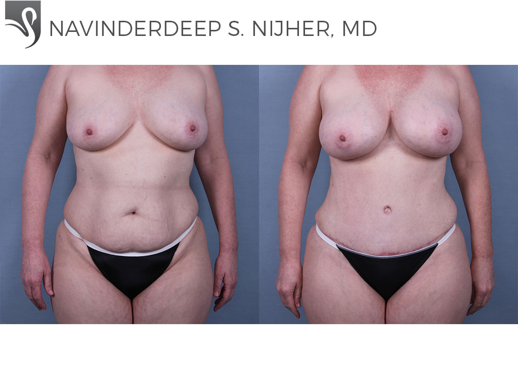 Before and After Image: Abdominoplasty (Tummy Tuck) Case #70490 - front