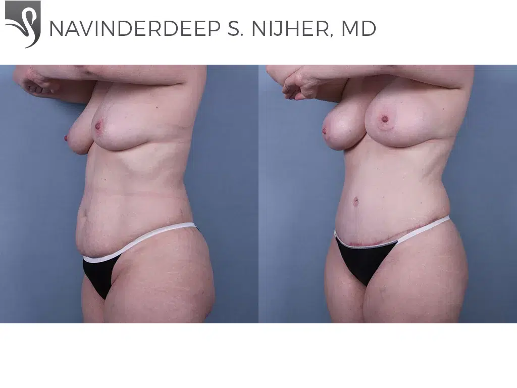 Before and After Image: Abdominoplasty (Tummy Tuck) Case #70490 - left-front-oblique