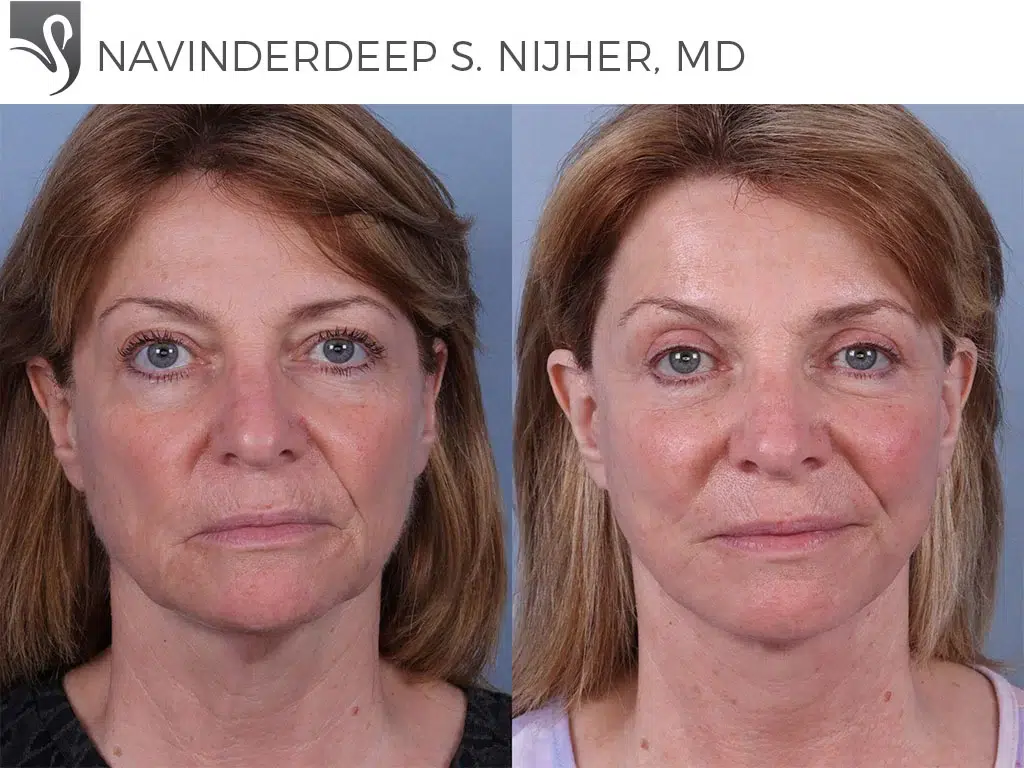 Before and After Image: Face Lift Case #70790 - front