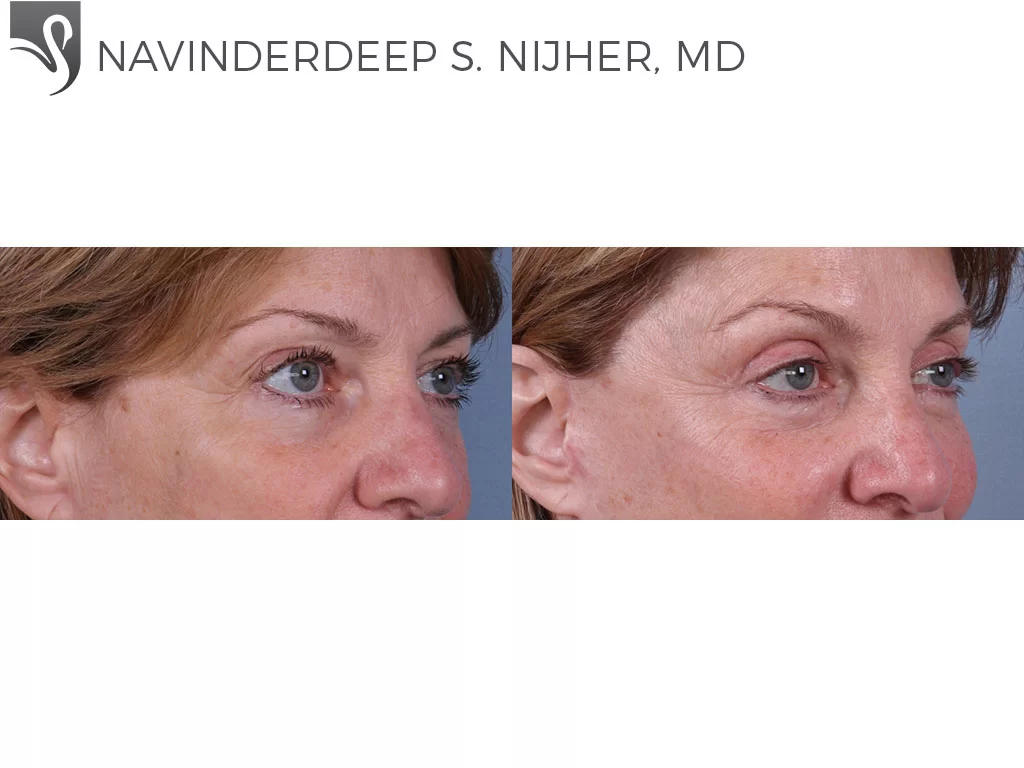 Before and After Image: Eyelid Surgery Case #70790 - right-front-oblique