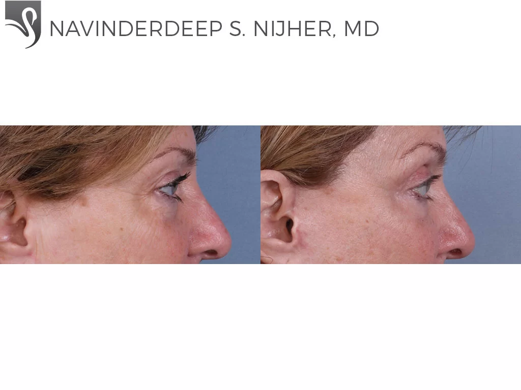 Before and After Image: Eyelid Surgery Case #70790 - right-side