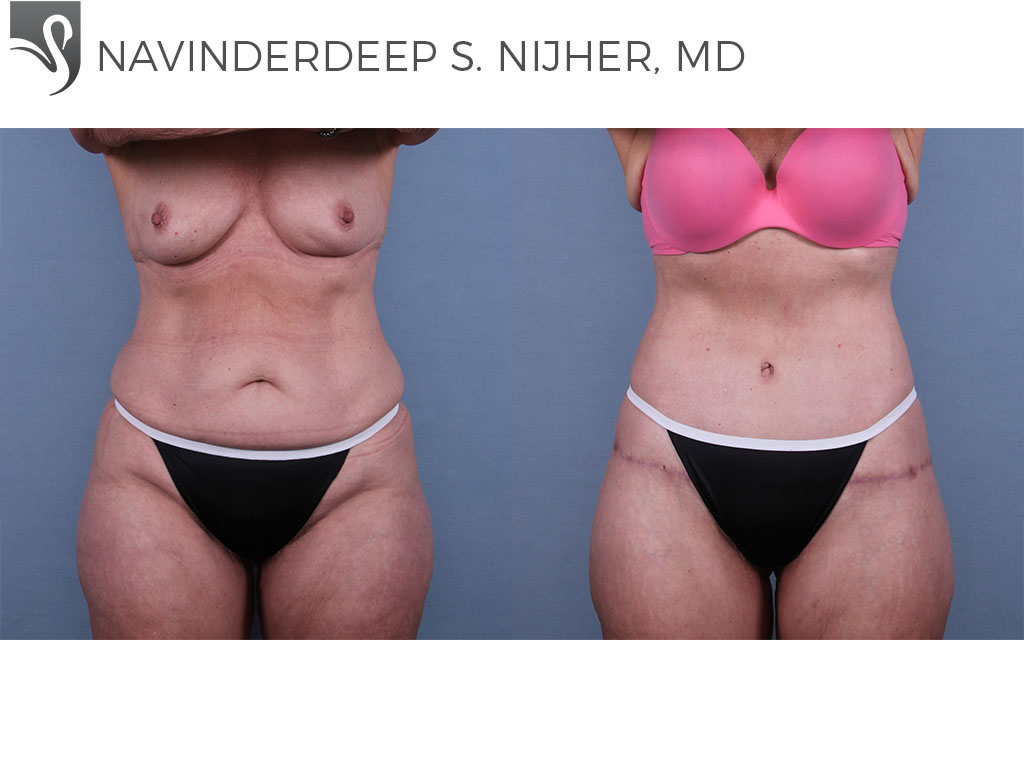 Before and After Image: Abdominoplasty (Tummy Tuck) Case #70960 - front