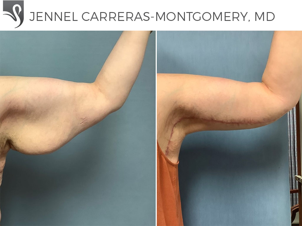 Before and After Image: Arm Lift Case #71023