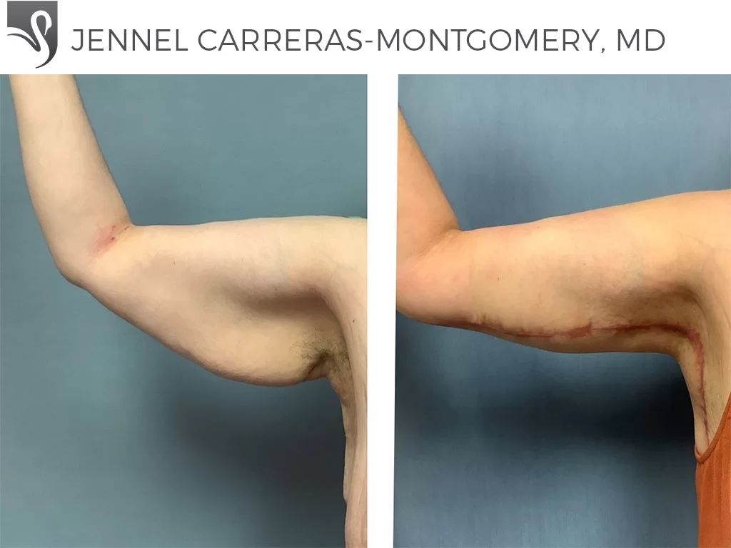 Before and After Image: Arm Lift Case #71023 - front