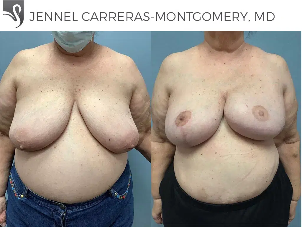 Before and After Image: Breast Reconstruction Case #71072