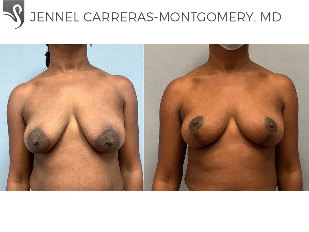 Before and After Image: Breast Lift (Mastopexy) Case #71294