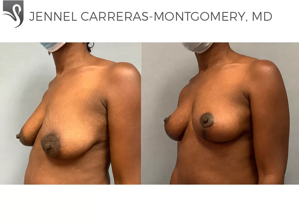 Before and After Image: Breast Lift (Mastopexy) Case #71294 - left-front-oblique
