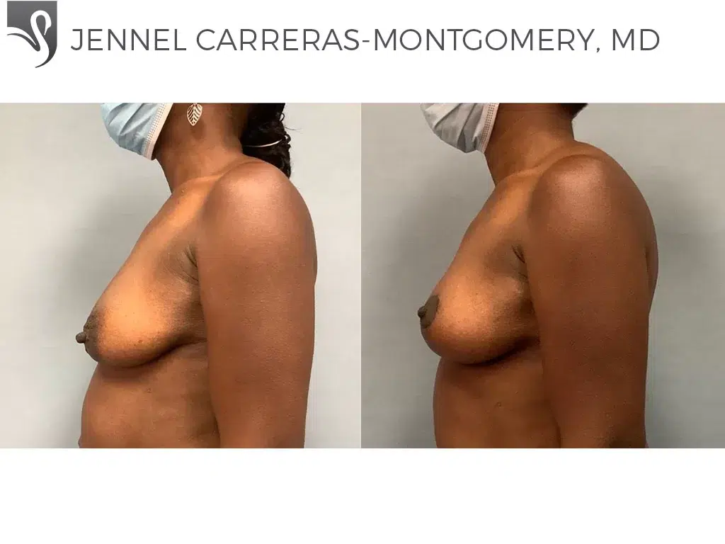 Before and After Image: Breast Lift (Mastopexy) Case #71294 - left-side