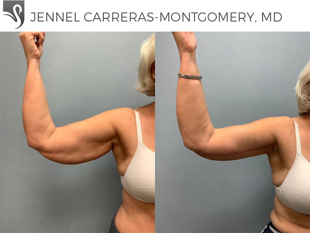 Before and After Image: Arm Lift Case #71346
