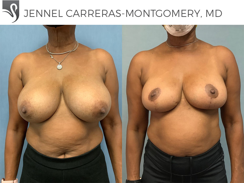 Before and After Image: Female Breast Reduction Case #71353 - front
