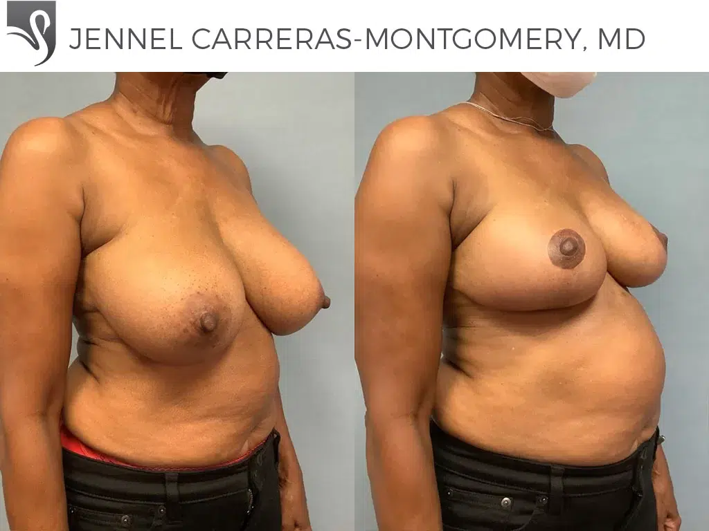 Before and After Image: Female Breast Reduction Case #71353 - right-front-oblique
