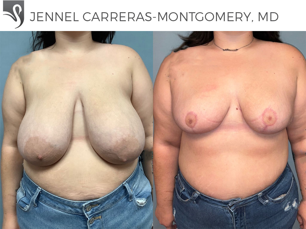 Before and After Image: Female Breast Reduction Case #71402 - front