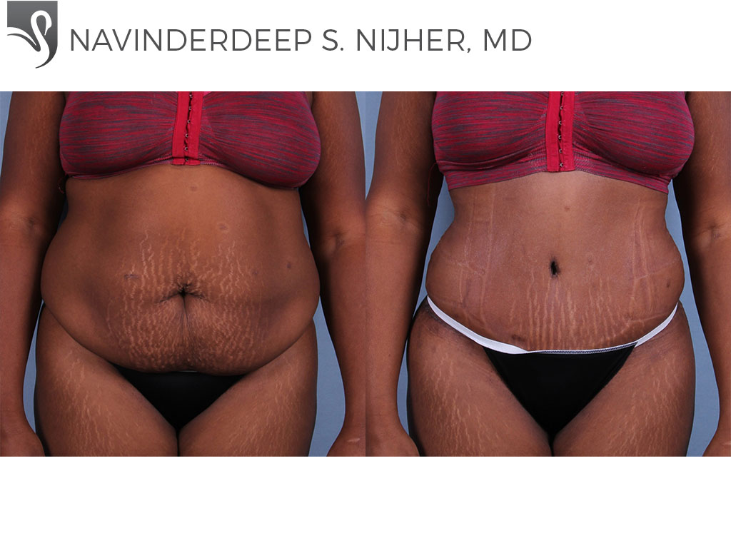 Before and After Image: Abdominoplasty (Tummy Tuck) Case #71494 - front