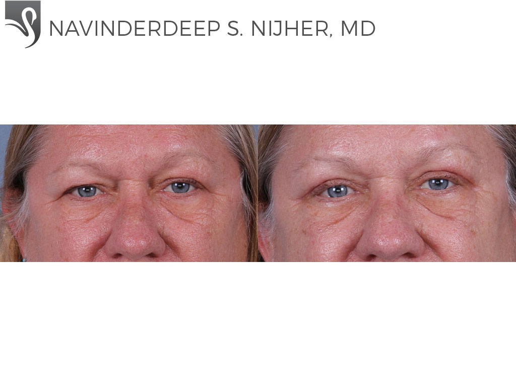 Before and After Image: Eyelid Surgery Case #71857 - front