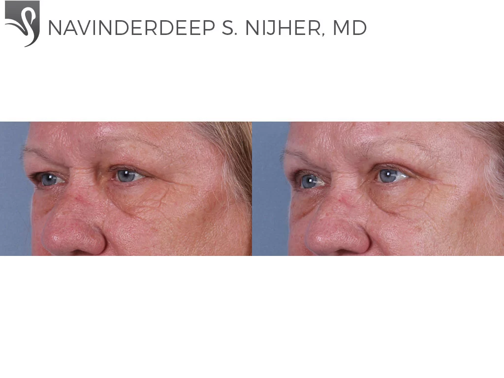 Before and After Image: Eyelid Surgery Case #71857 - left-front-oblique