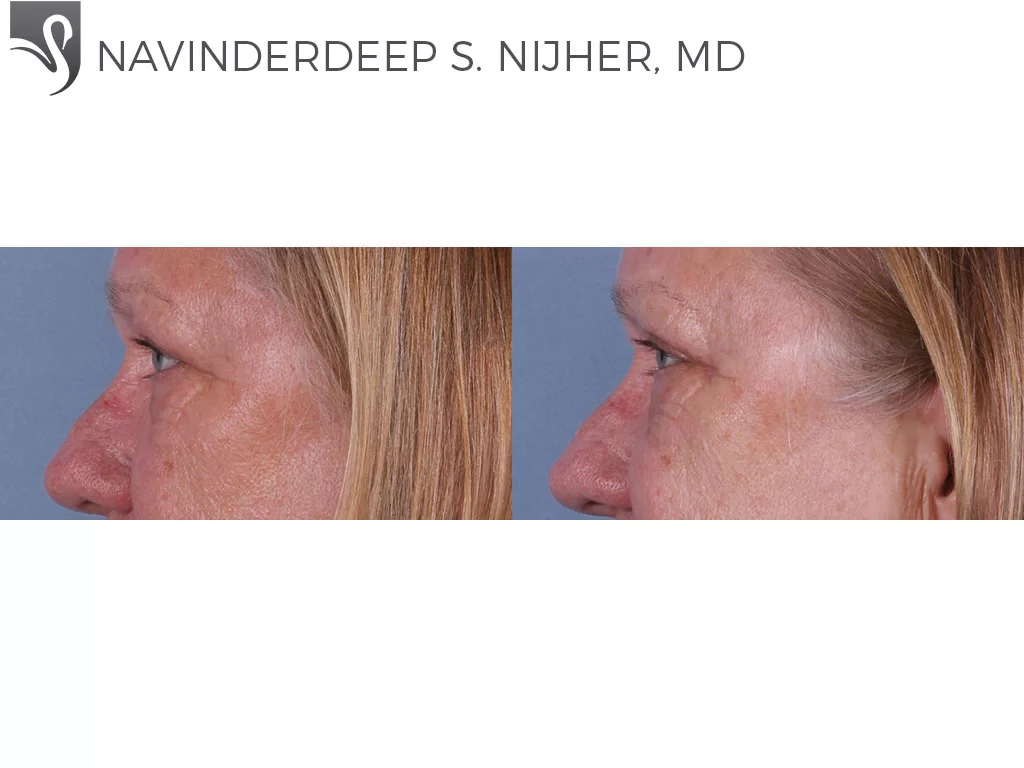 Before and After Image: Eyelid Surgery Case #71857 - left-side