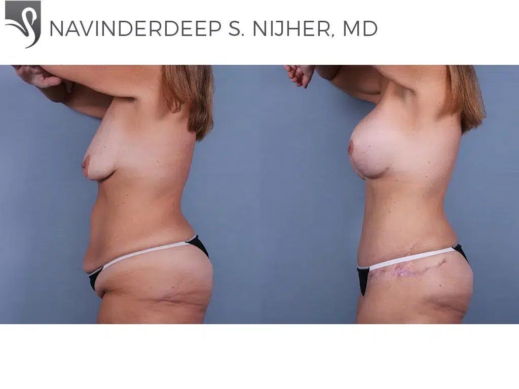 Before and After Image: Mommy Makeover Case #71956 - left-side