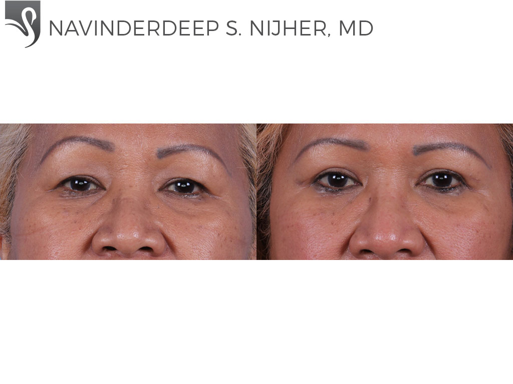 Before and After Image: Eyelid Surgery Case #72033 - front