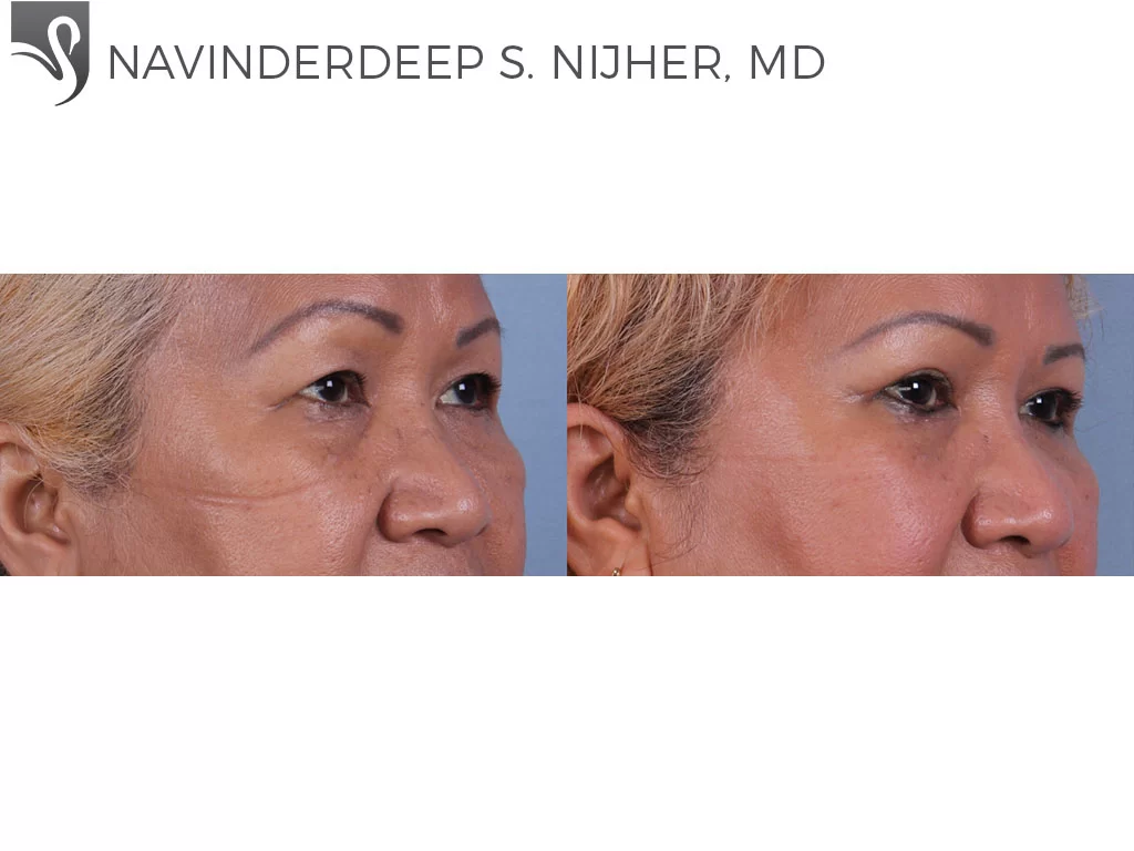 Before and After Image: Eyelid Surgery Case #72033 - right-front-oblique