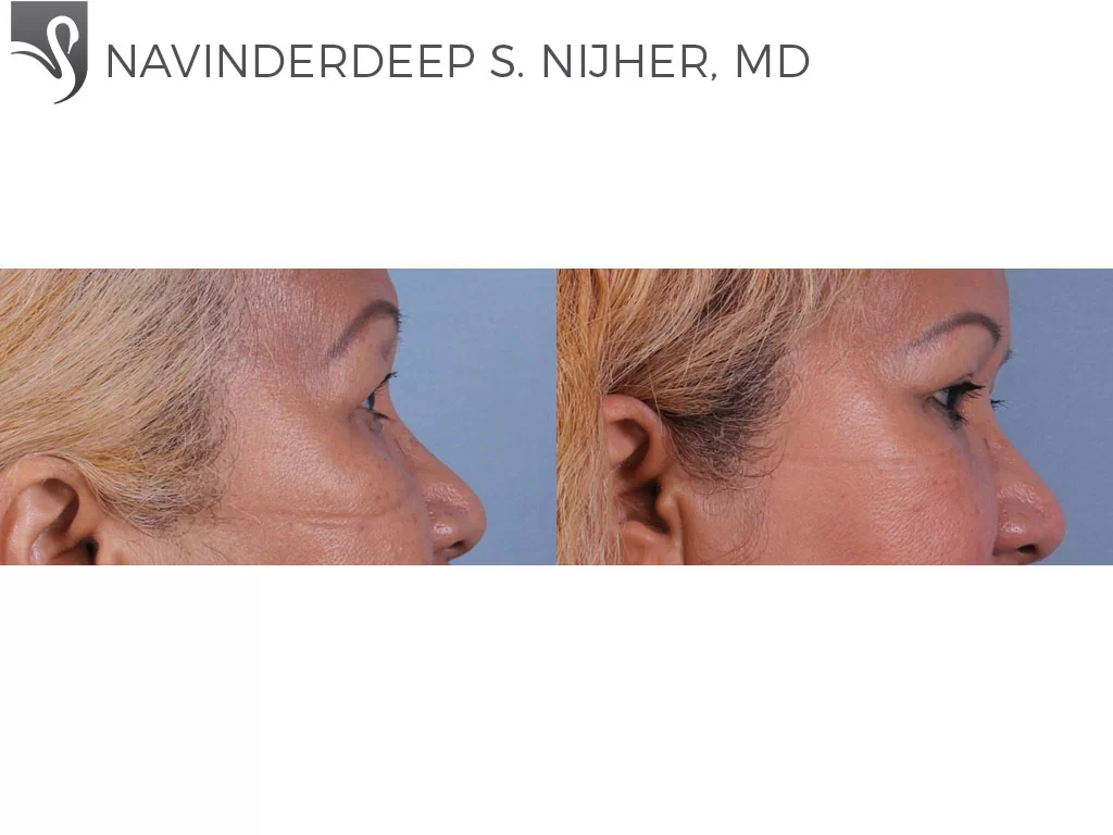 Before and After Image: Eyelid Surgery Case #72033 - right-side
