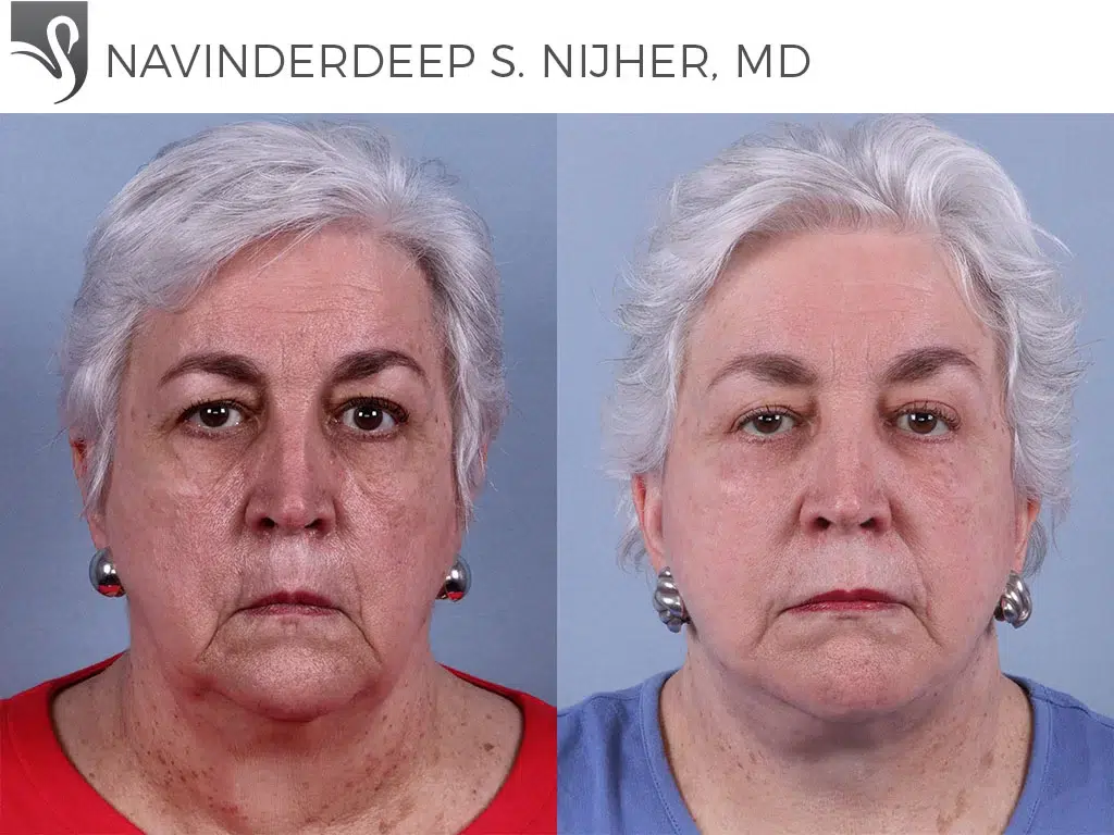 Before and After Image: Face Lift Case #72053 - front