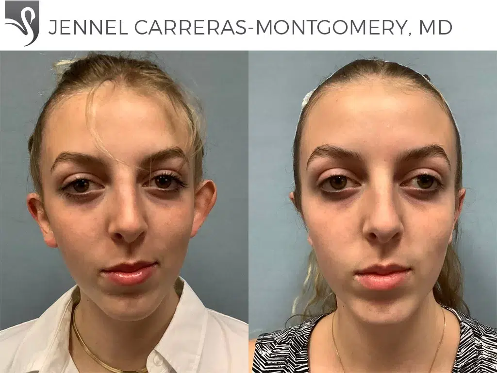 Before and After Image: Otoplasty Case #72080 - front