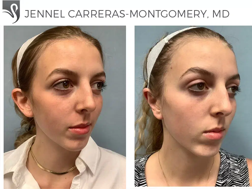 Before and After Image: Otoplasty Case #72080 - right-front-oblique