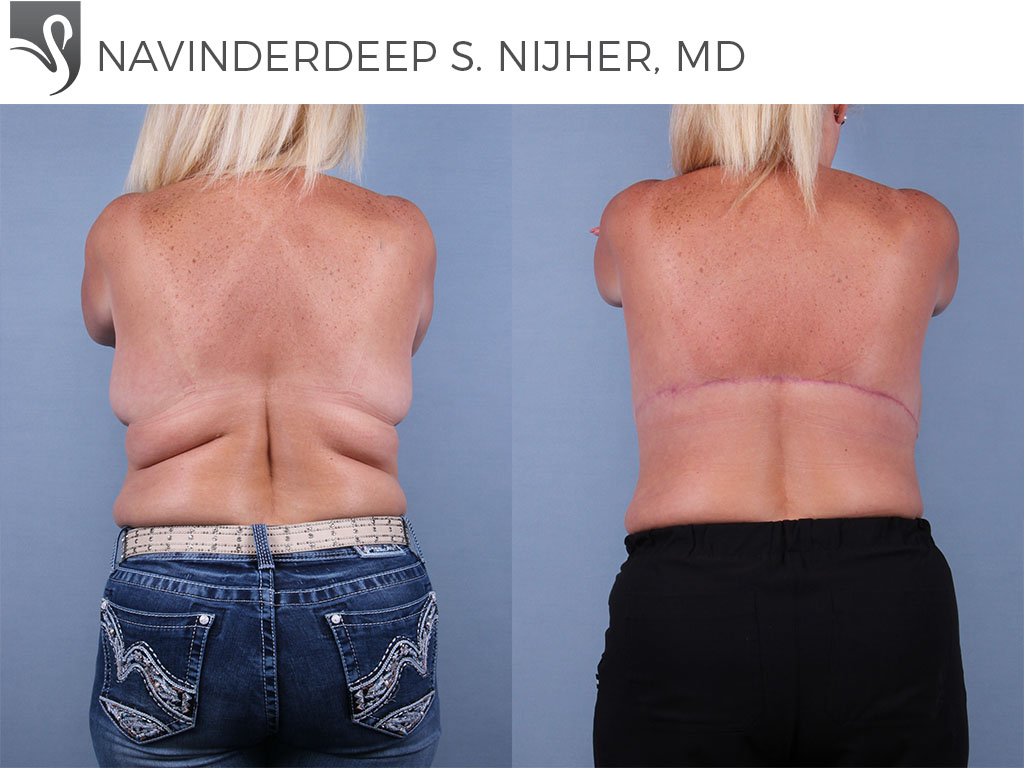 Before and After Image: Body Contouring Case #72099