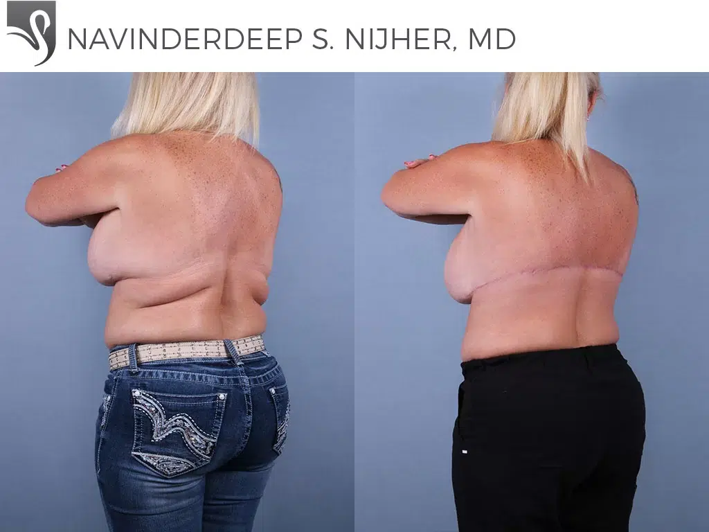 Before and After Image: Body Contouring Case #72099 - left-back-oblique