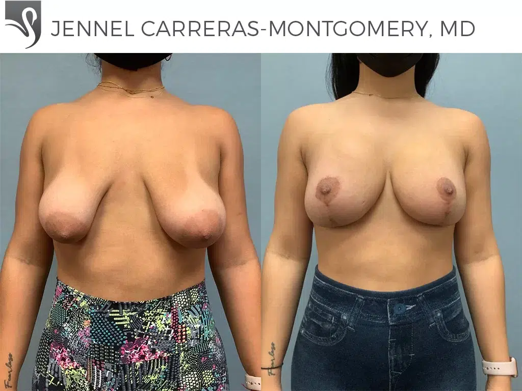 Before and After Image: Breast Lift (Mastopexy) Case #72232 - front