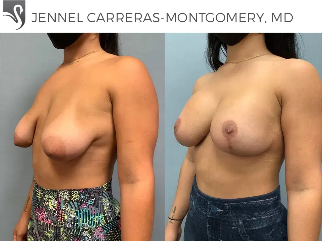 Before and After Image: Breast Lift (Mastopexy) Case #72232 - left-front-oblique