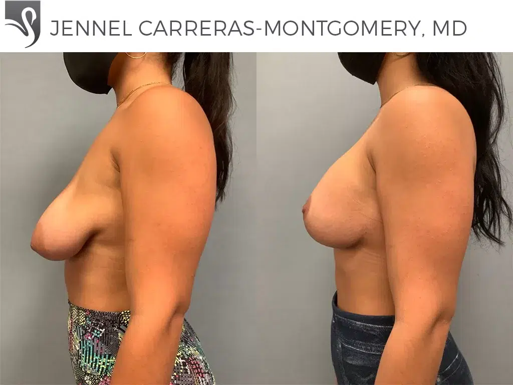 Before and After Image: Breast Lift (Mastopexy) Case #72232 - left-side