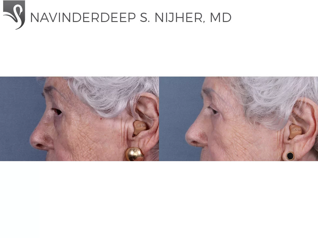 Before and After Image: Eyelid Surgery Case #72248 - left-side