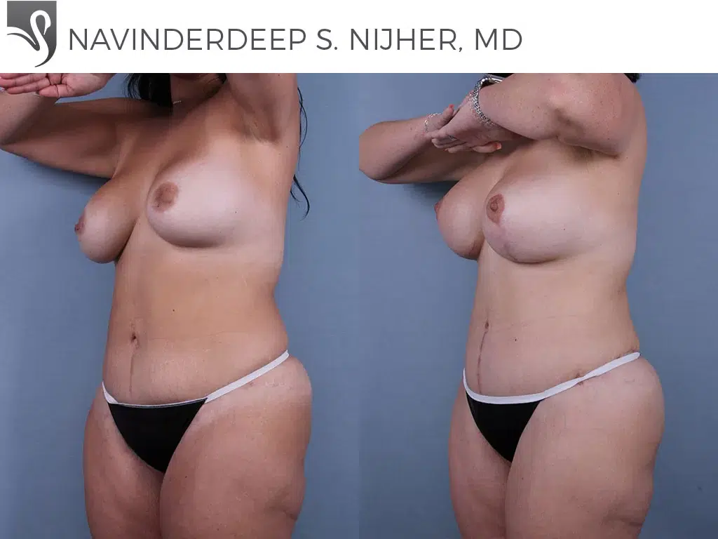 Before and After Image: Abdominoplasty (Tummy Tuck) Case #72317 - left-front-oblique