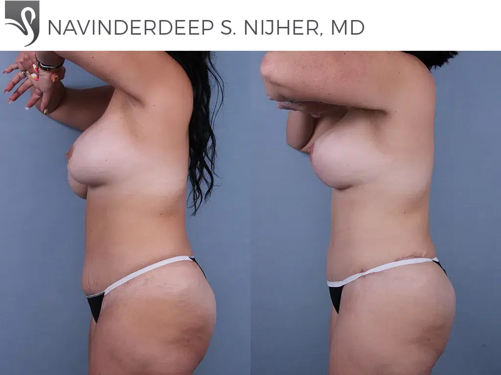Before and After Image: Abdominoplasty (Tummy Tuck) Case #72317 - left-side