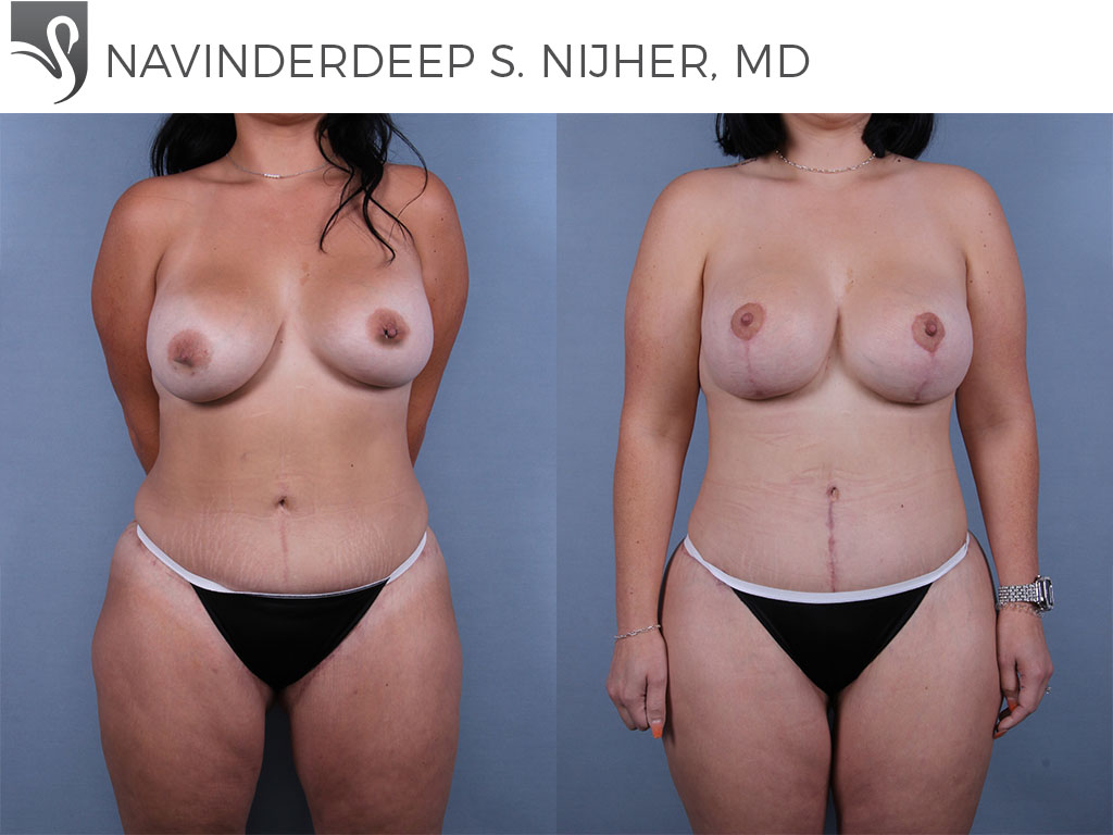 Before and After Image: Mommy Makeover Case #72317