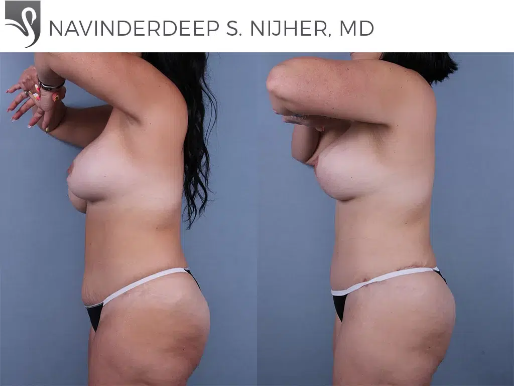 Before and After Image: Mommy Makeover Case #72317 - left-side