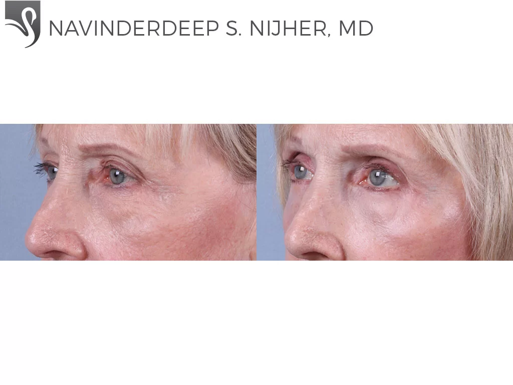 Before and After Image: Eyelid Surgery Case #72454 - left-front-oblique